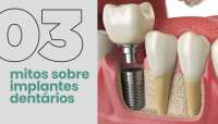 3 Mitos sobre Implantes Dentários