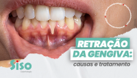 Causas e tratamentos da retração da gengiva