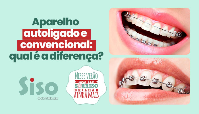 Aparelho autoligado e convencional: qual é a diferença?