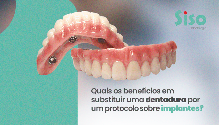 Quais os benefícios em substituir uma dentadura por um protocolo sobre implantes? Quais os benefícios em substituir uma dentadura por um protocolo sobre implantes?