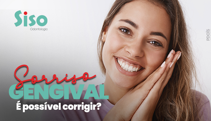Sorriso gengival, é possível corrigir? Sorriso gengival, é possível corrigir?